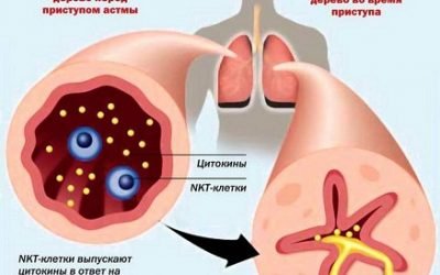 Причини бронхіальної астми, всіх форм