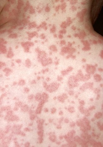 Що таке алергічний нежить і з за чого він виникає?