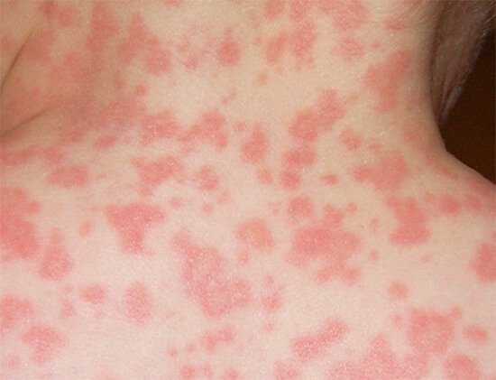 Ознаки алергічного нежитю
