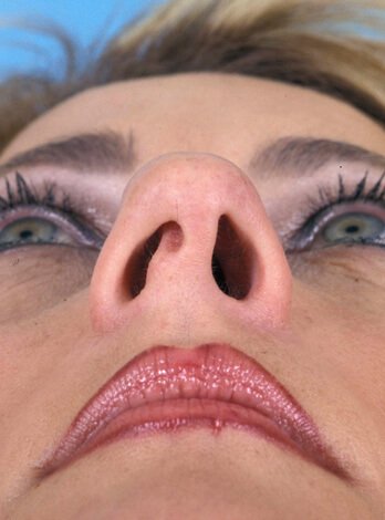 Чому розвиваються постійний нежить з ранку і нічна закладеність носа без нежиті?