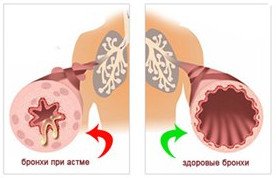 Лікування бронхіальної астми народними засобами