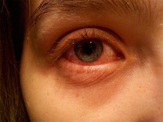 Які краплі вибирати хворим з гіпертонією і глаукомою при нежиті?
