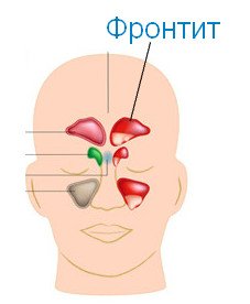 Острый фронтит. Причины возникновения фронтита. Воспаление лобной пазухи.