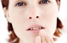 Застуда на губі, як швидко лікувати, мазі та засоби