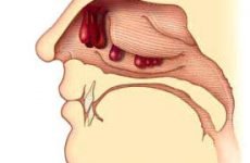 Поліпозний синусит: симптоми і лікування