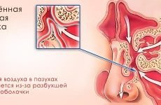 Симптоми і лікування гострого набряково-катарального гаймориту