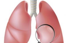 Тест: Як запідозрити туберкульоз легень?