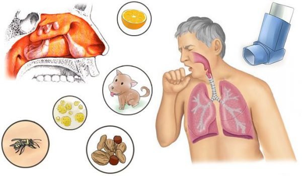 Алергічний гайморит: причини, симптоми, лікування, ускладнення та профілактика