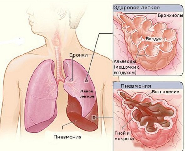 Ускладнення і наслідки пневмонії під час і після хвороби