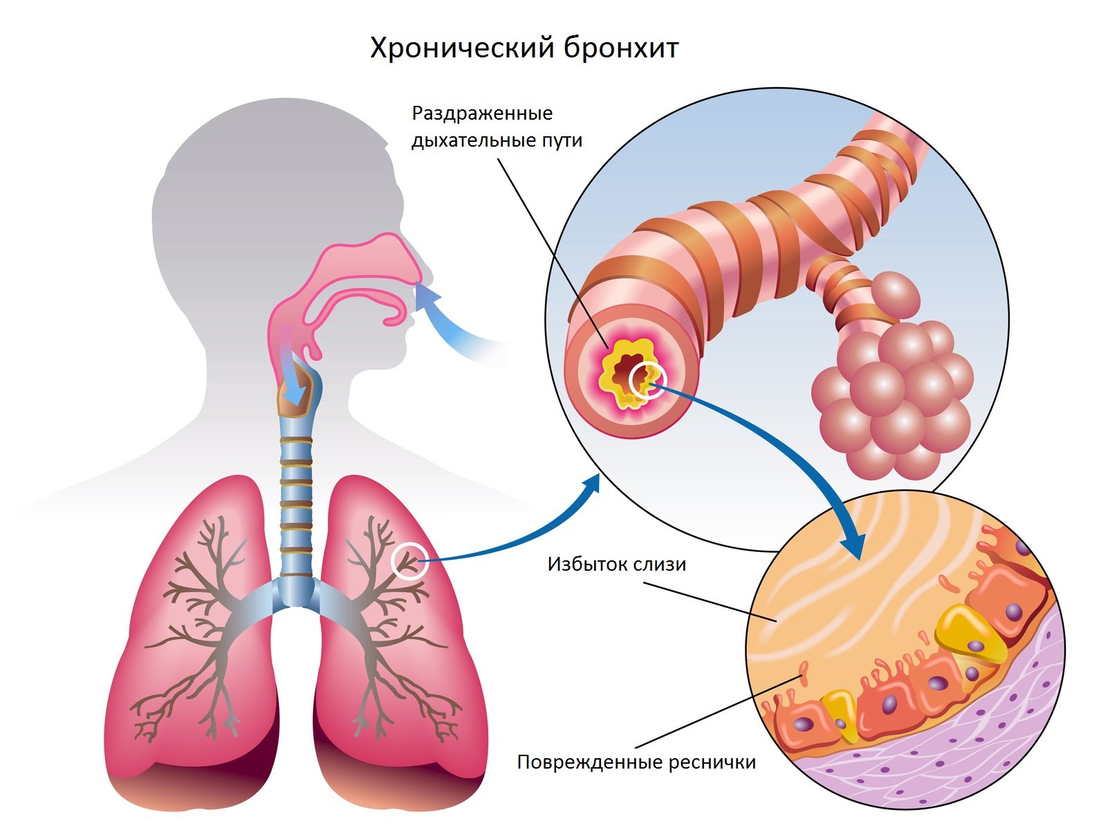 Профессиональные болезни легких