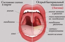 Постійно червоне горло – лікування за порадами доктора Комаровського