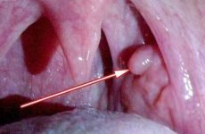 Причини появи поліпів у горлі і лікування патології