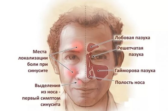 Що таке синусит: симптоми, причини, лікування та види синуситів