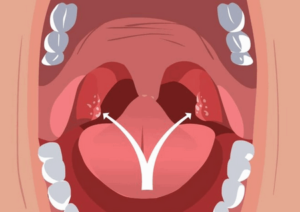 Гнійні і кавернозні пробки в горлі: причини виникнення, методи лікування та профілактики