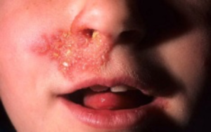 Що провокує нежить в носі і як її лікувати?