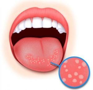 Бульбашки на стінках горла – як лікувати, причини появи
