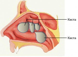 Кістозний синусит: симптоми і лікування захворювання