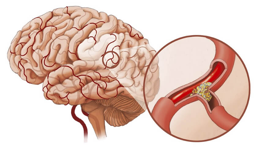 Діагностика, симптоми і лікування атеросклерозу судин головного мозку