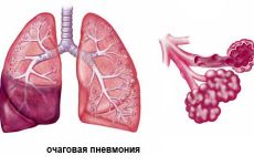 Вогнищева пневмонія: особливості, види, симптоми і лікування