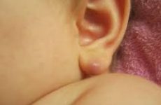 Шишка на мочці вуха – чим лікувати, як позбавитися від ущільнення