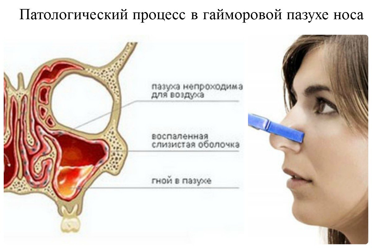 Заложило нос что делать форум. Гайморовы пазухи гайморит. Воспаление гайморовых пазух.