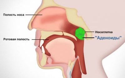 Аденоїди в носі у дитини: симптоми та ефективне лікування