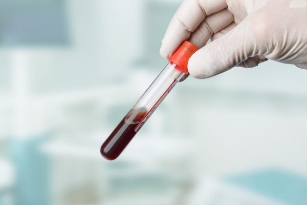 Аналіз крові при гаймориті: як проводиться і що показує