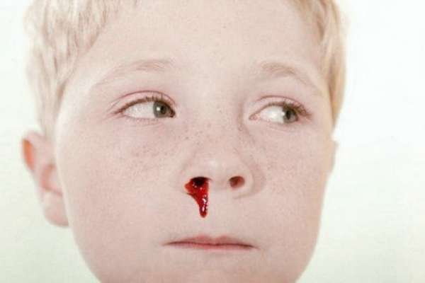 Аскорутин дітям при носових кровотечах: дозування, інструкція по застосуванню