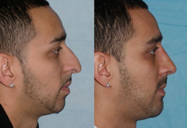 Безопераційна ринопластика носа: види, як роблять і догляд після