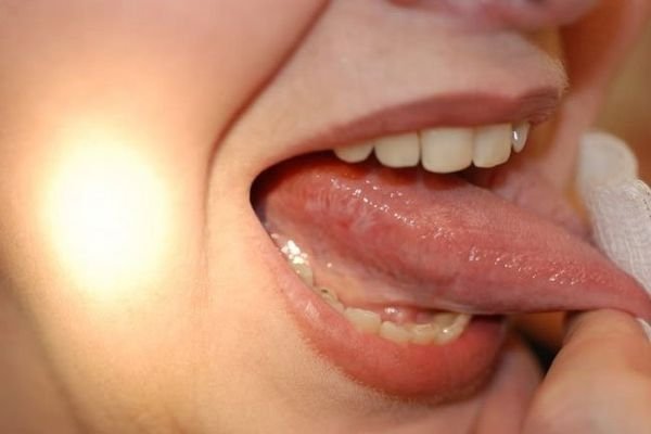 Болить горло і мова: причини, симптоми, лікування та профілактика
