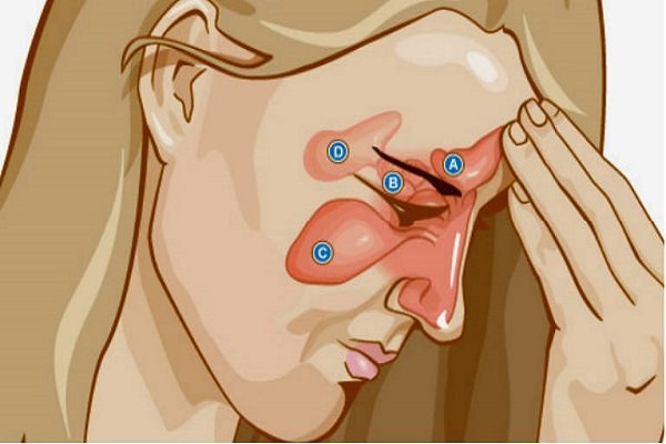 Болить лобова пазуха носа: що робити, причини і лікування