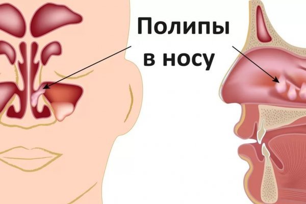 Болять пазухи носа без нежиті: що робити і як лікувати?
