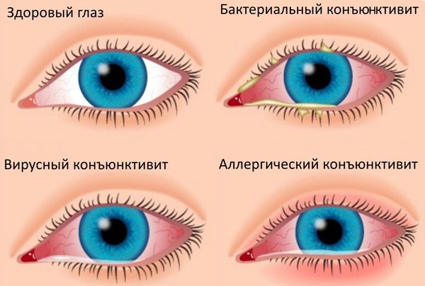 Сверблять очі і нежить, закладений ніс: причини і профілактика