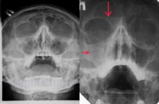 Фронтит на рентгенівському знімку і МРТ: коли необхідний, що показує?