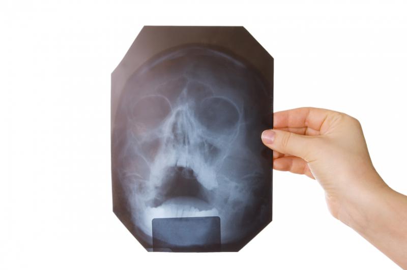 Гайморит на знімку: як виглядає рентген пазух носа
