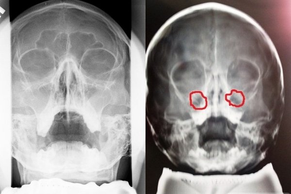 Гайморит на знімку: як виглядає рентген пазух носа