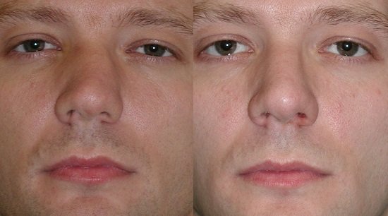 Викривлення носової перегородки: причини і лікування операцією і без