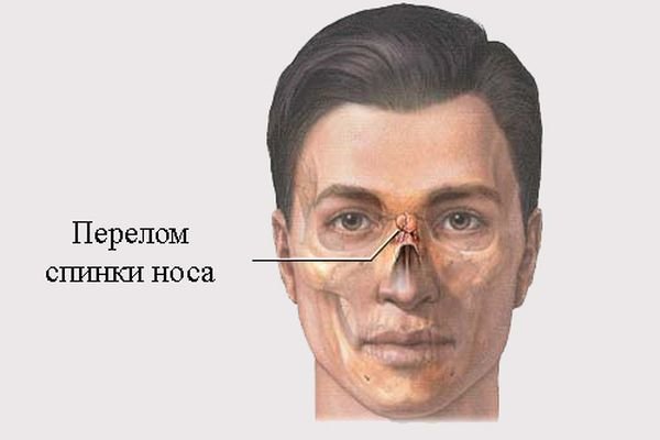 Як визначити перелом носа або забій: основні відмінності при травмі