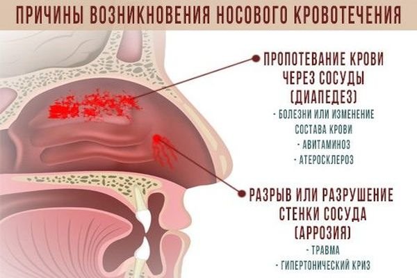Як зміцнити судини носа при частих кровотечах?