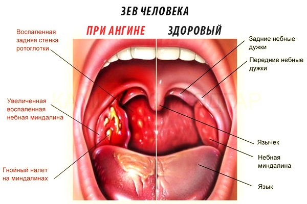 Каметон від нежитю і закладеності носа: як застосовувати препарат