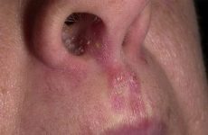 Кандидоз у носі: ефективне лікування молочниці носоглотки