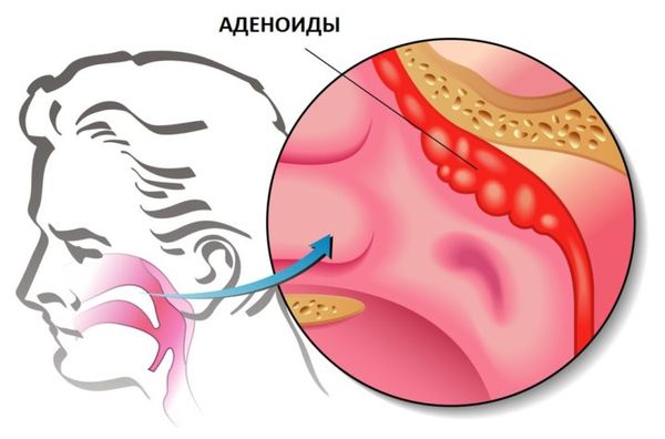 Краплі при аденоїдах: у дітей спреї, антибіотики і ліки в ніс, щоб кращі дихати