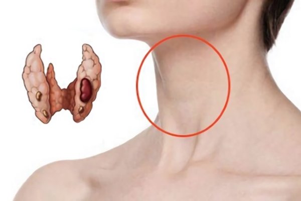 Кістозно-солідне утворення щитовидної залози: симптоми і лікування