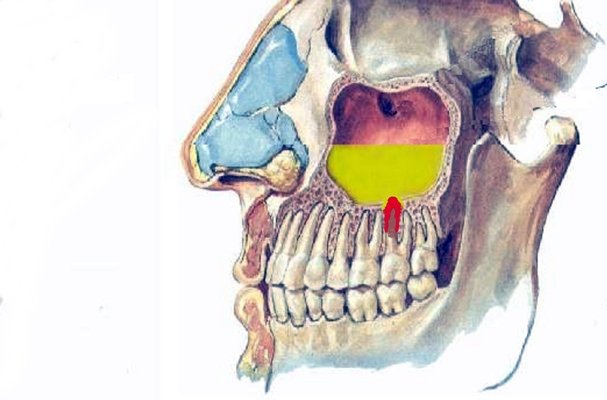 Одонтогенний гайморит (синусит) з-за хворого зуба: симптоми і лікування
