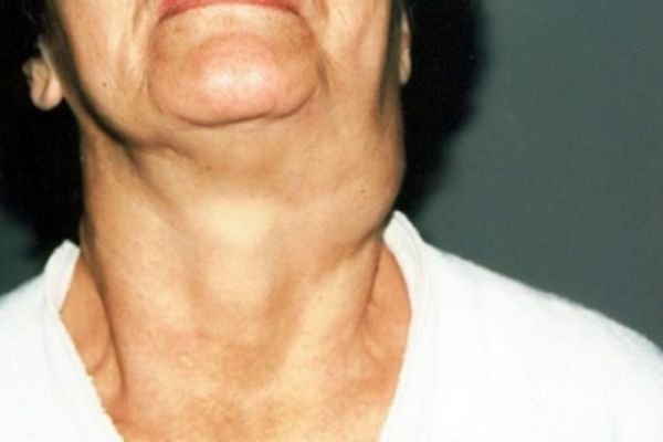 Пухлина на шиї праворуч, ліворуч або ззаду: симптоми і лікування