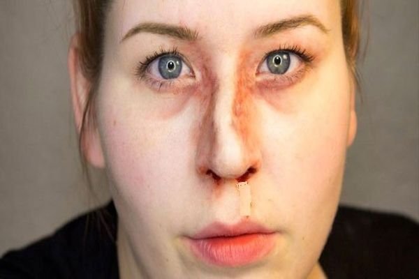 Перелом носа: ступінь тяжкості шкоди здоровю при зміщенні перегородки