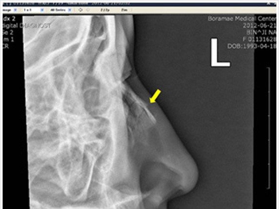 Перелом носа зі зміщенням і без: ознаки, симптоми і лікування