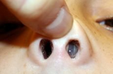 Поліпи в носі у дитини: як виглядають, симптоми і лікування