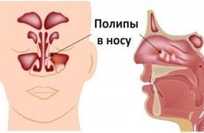 Поліпи в носі у дорослих і дітей: симптоми і лікування