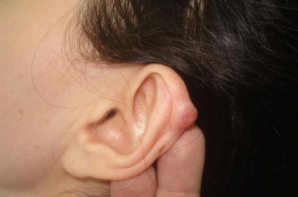 Рак вуха: симптоми і ознаки, в мочці вуха з'явився кулька (шишка) і болить